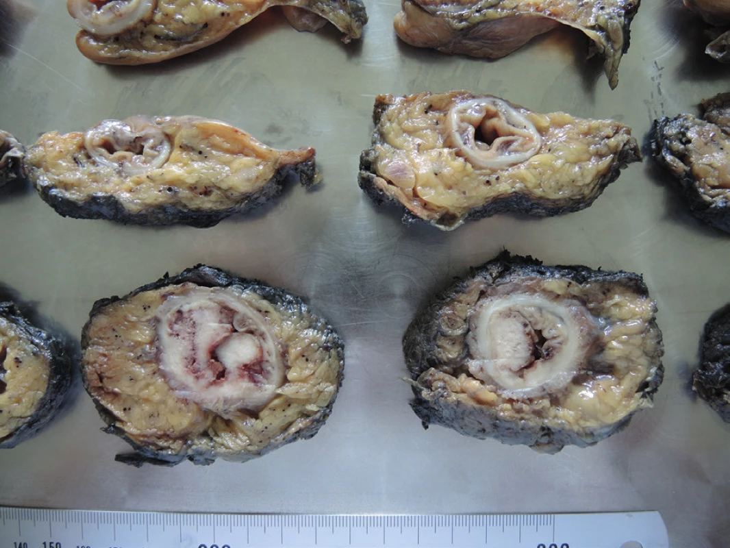 Transverzální řezy resekátu
Fig. 5. Cross sections of resected specimen