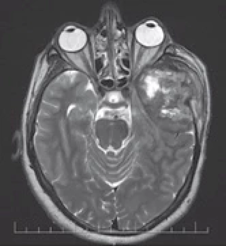 Pre-operative MRI – fi rst case.