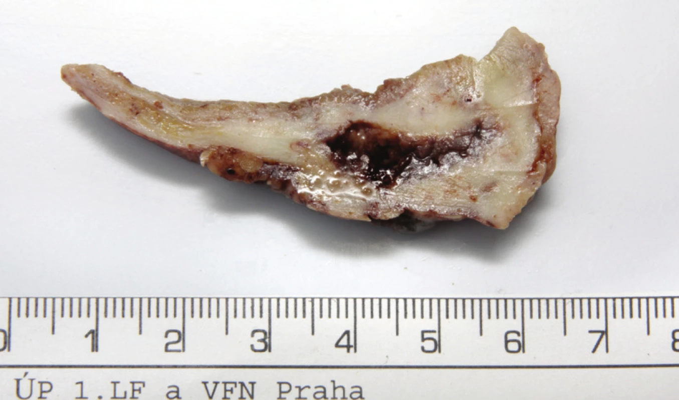Fotografie – průřez stěnou žlučníku s nálezem ve fundu
Fig. 4. Photo – section through the gall bladder wall with a finding in the fundus
