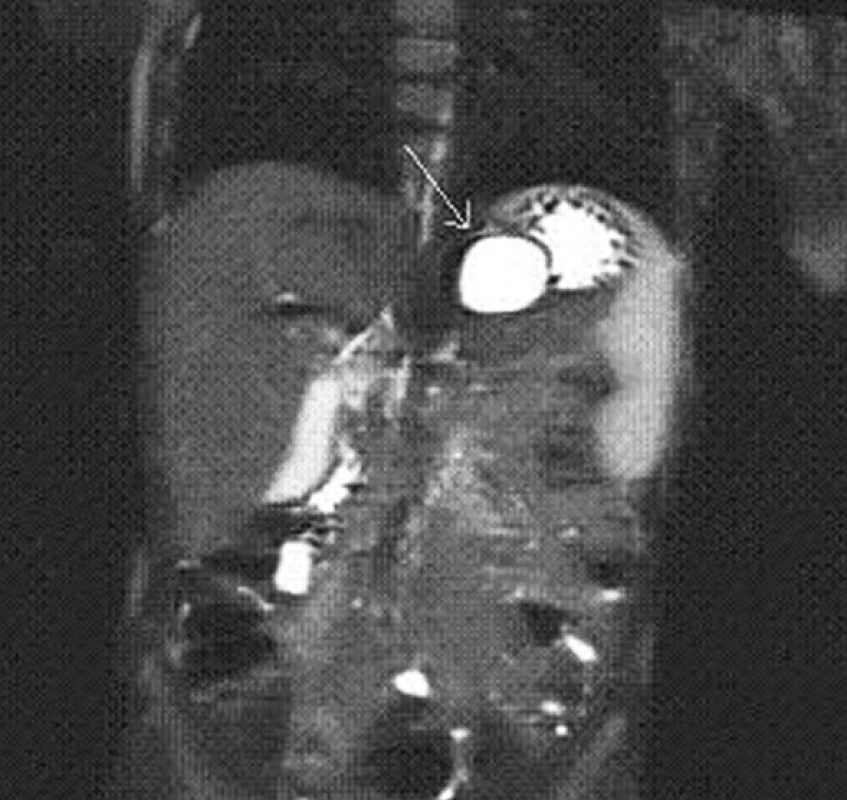 MRI – frontální řez, cysta označena šipkou
Fig. 2: MRI – frontal view, the cyst is marked with an arrow