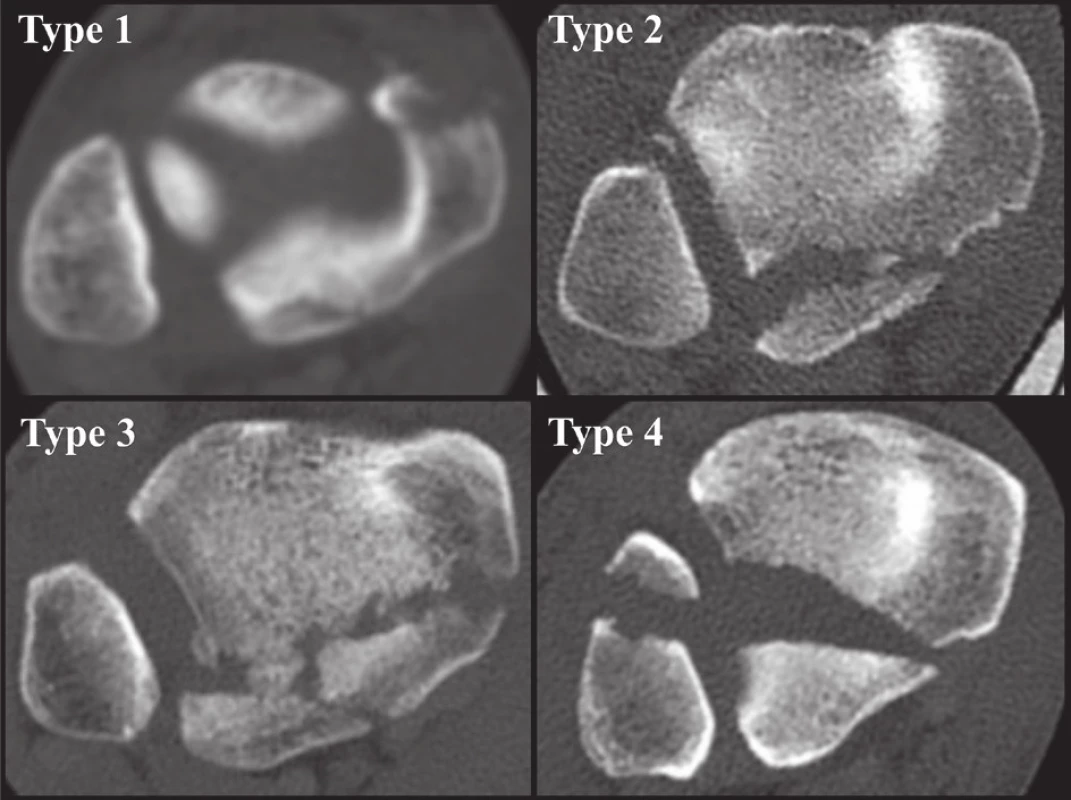Anatomická 3D CT klasifikace z r. 2015 [34]
Jednotlivé typy z Obr. 6 na CT transverzálních CT řezech.
Fig. 9: Anatomical 3D CT classification published in 2015 [34]
Individual types from Fig. 6 on transverse CT scans.