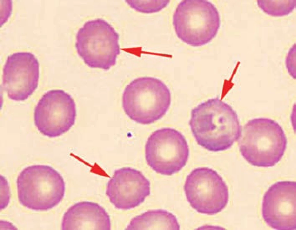Detail nátěru periferní krve pacienta č. 2 s ojedinělými echinocyty. 
Fig. 4. Detail of the patient’s peripheral blood smear No. 2 with isolated echinocytes.