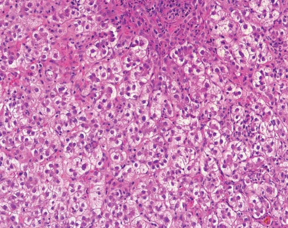 Fibrocholestatická hepatitida s minimálním zánětem v portálních polích, nápadně zduřelými cholestatickými hepatocyty a počínající peritrabekulární fibrózou.