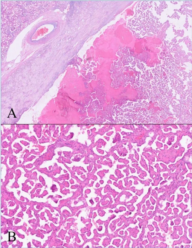 Histologický preparát papilární renální neoplazie s reverzní polaritou. A) HE, zvětšení 20×; B) HE, zvětšení 90×.  Fig. 3. Histological specimen of papillary renal neoplasm with reverse polarity. A) HE, magnification ×20; B) HE, magnification ×90. 