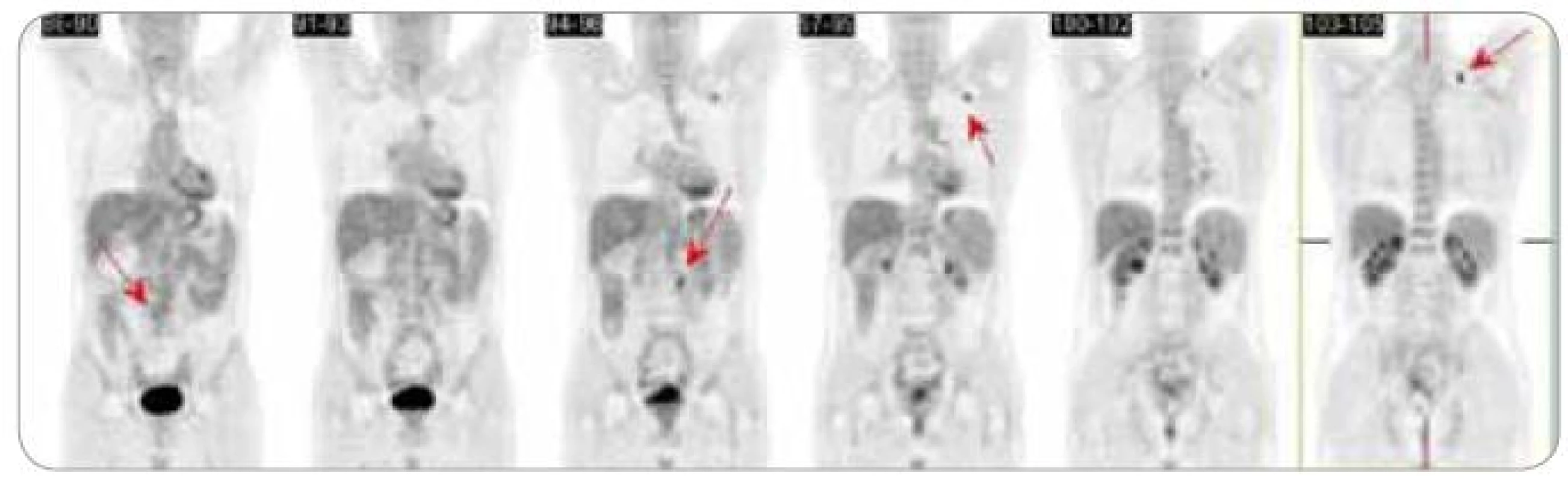 PET + CT – říjen 2008.