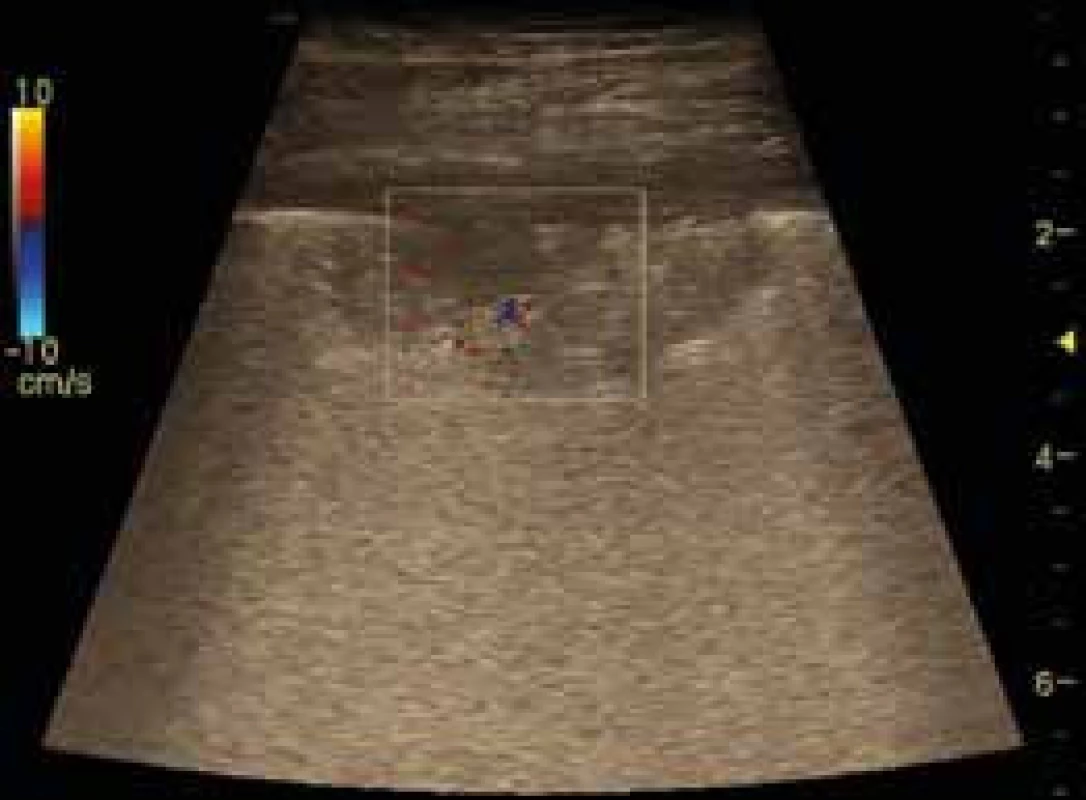Periferní plicní embolus – infarkt plic