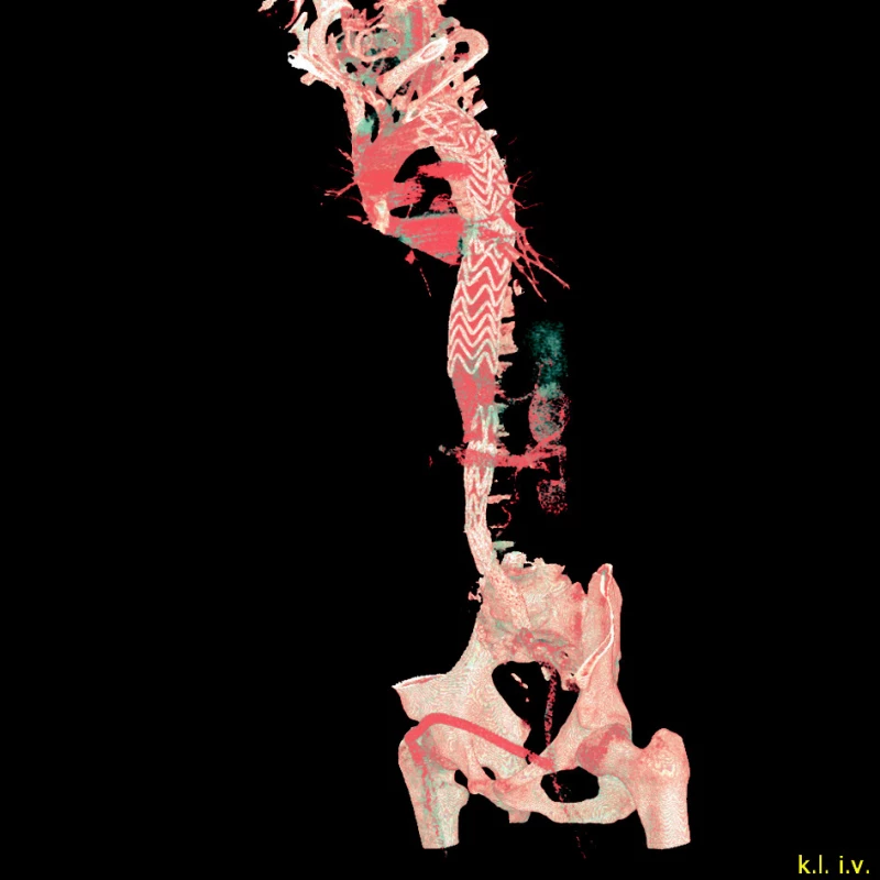 Aortouniiliacký stentgraft s nekrytým suprerenálním hrdlem a femorofemorální zkřížený bypass
Fig. 4. An aortouniiliac stentgraft with an open suprarenal column and a femoro-femoral cross-over bypasss

