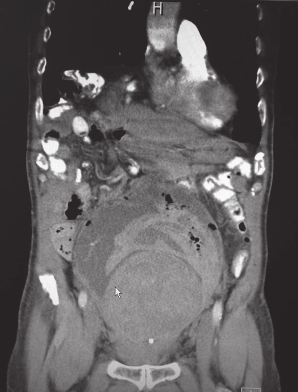 CT sken s patrnou objemnou prostatou dosahující k pupku, zbytek močového měchýře je vyplněný koaguly
Fig. 1. CT scan with a huge prostate reaching to the belly buttom, the rest of the bladder is filled clot with coagulum