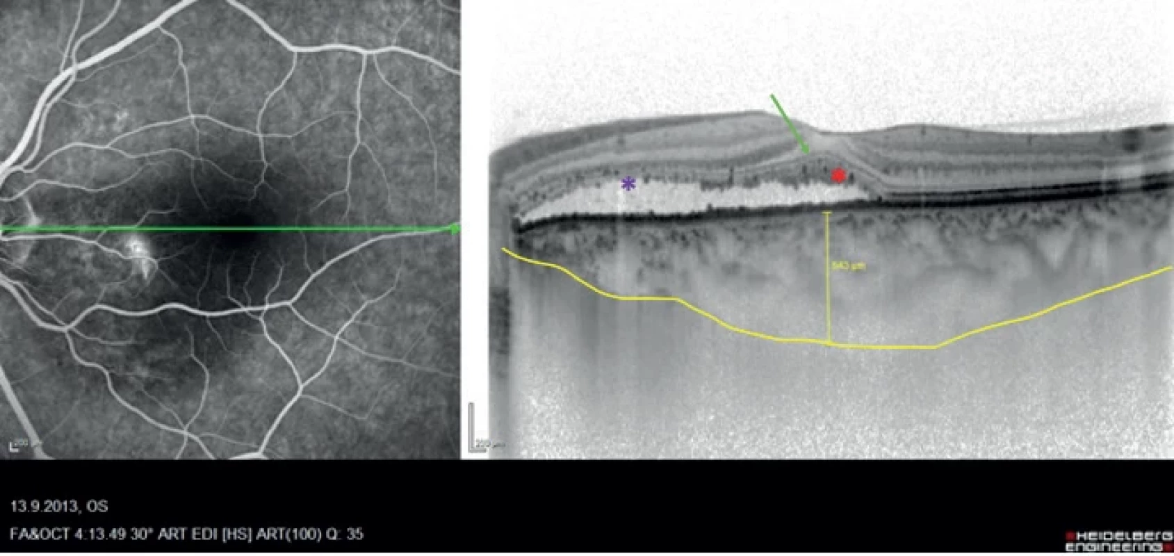 Combined image of fluorescein angiography and transfoveolar linear scan of optical coherence tomography (Heidelberg Spectralis, Myslík Manethová)