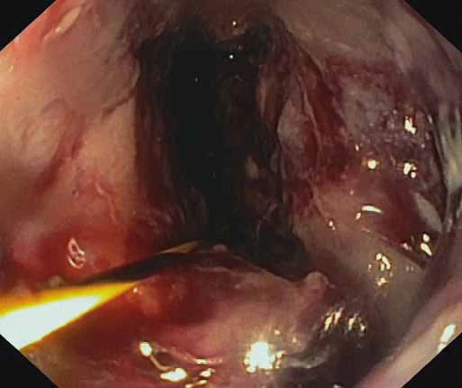 Viabilné granulačné tkanivo na spodine nekrózy po úspešnej nekrektómii.
Fig. 4. Viable granulation tissue after a successful necrectomy.