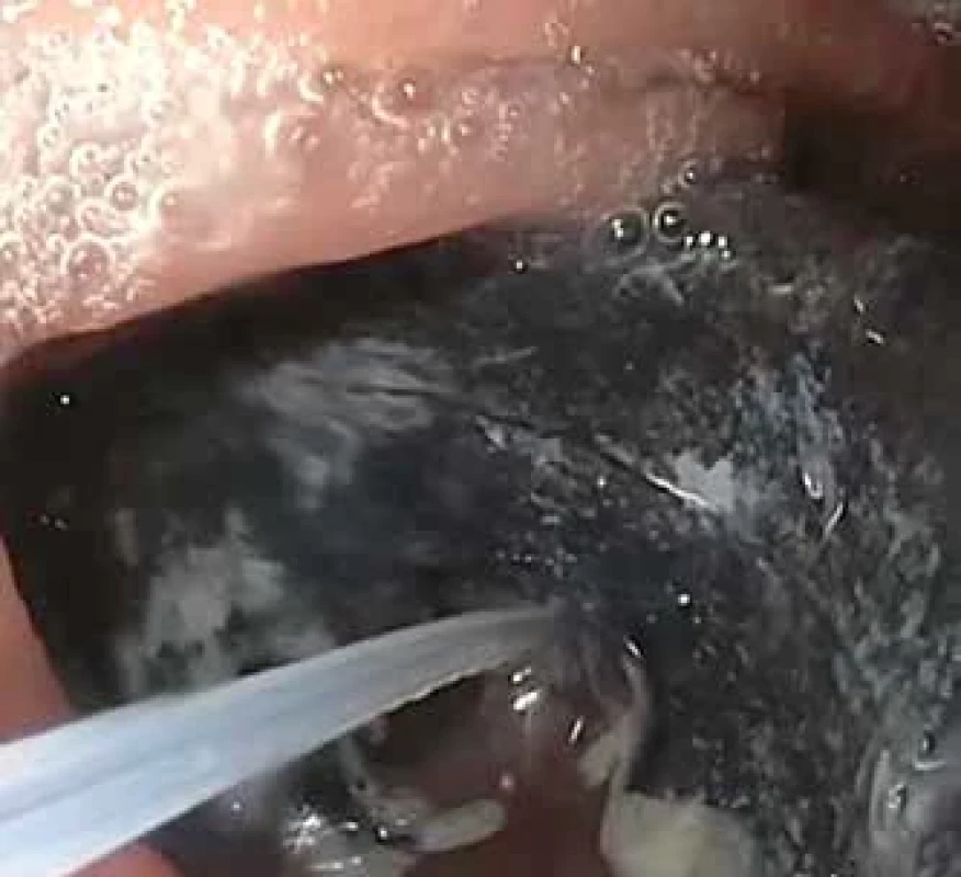 A.M.I. Aigner Gastric Band Cutter zařízení – řezací drát zavedený pracovním kanálem endoskopu [15].