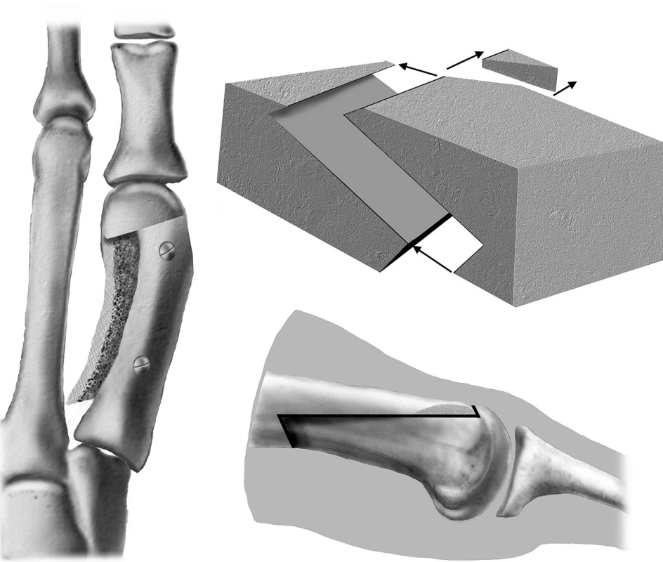 Schéma scarf osteotomie diafýzy I. MTT.