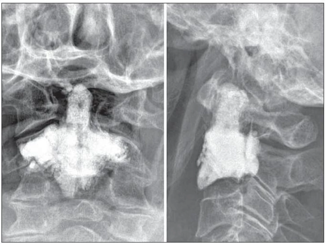 Vertebroplastika pro osteolytickou metastázu čepovce byla indikována u 72leté pacientky s metastázou plazmocytomu.
Důležité při tomto výkonu není pouze vyplnění zubu čepovce, ale především nosných struktur, jimiž jsou laterální masy a baze obratlového těla.