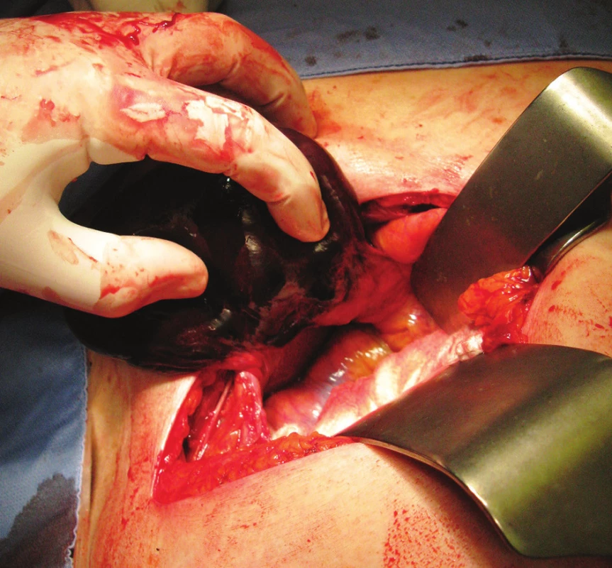Gangrenózní hydropický žlučník, torze v místě cévního svazku
Fig. 3: Gangrenous and hydropic gallbaldder, torsion of the vascular bundle