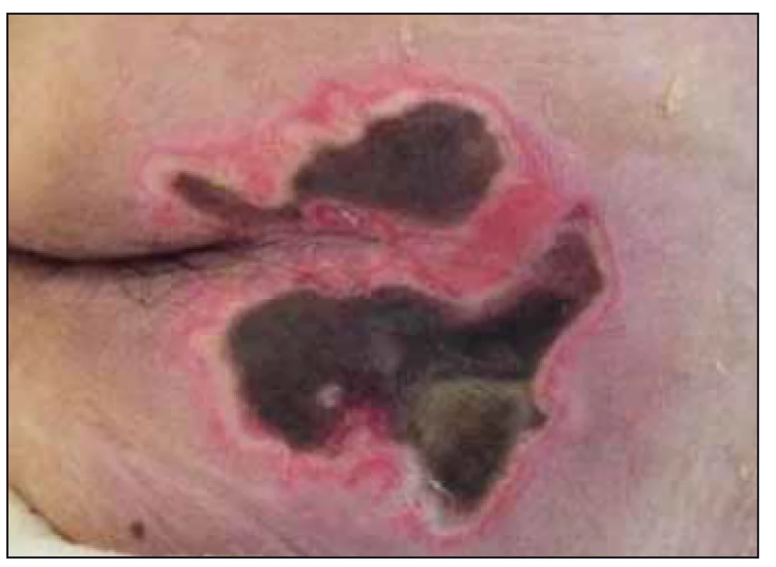 Case study B – when patient was
transferred to the Intensive Care Unit of
the Pulmonary clinic, necrosis in the sacral
area.<br>
Obr. 3. Klinický prípad B – po preklade pacienta
na jednotke intenzívnej starostlivosti
Kliniky pneumológie, nekróza v sakrálnej
oblasti.