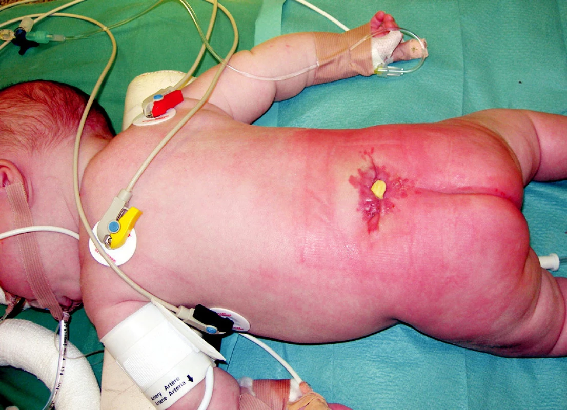 Sekvestrácia syntetického materiálu použitého na náhradu fascie pri otvorenom type NTD
Fig. 1. Synthetic material sequestration as result of fascial substitution in open type of spina bifida