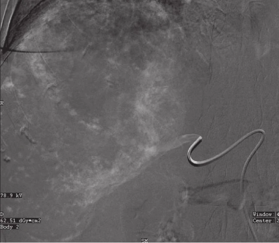 Transarteriální embolizace gigantického hemangiomu o průměru 13 cm pravého laloku jater směsí Histoacryl-Lipiodol (1:10)
Fig. 4: Transarterial embolization of a giant hemangioma (13 cm in diameter) of the right liver lobe using the Histoacryl-Lipiodol mixture (1:10)
