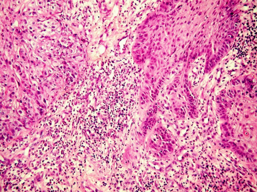 Mikrofotografia stredne diferencovaného SCC v materiály z okraja dekubitu (hematoxilín – eozín, 200x).
Fig. 4. A microphotograph of a moderately differentiated SCC in the preparation from the decubital margin (hematoxyllin-eosine staining, 200x).
