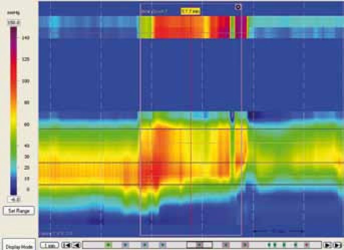 Dysynergní defekace typu II – neadekvátní zvýšení tonu análního svěrače při simulované defekaci.
Fig. 12. Dyssynergic defecation type II – inadequate elevation of anal sphincer tone in simulated defecation.