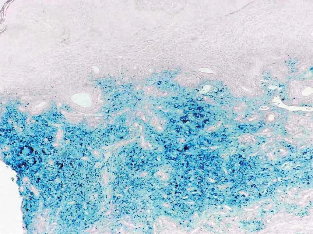 Depozity hemosiderínu zafarbené na modro (Perlsovo farbenie, 25x).