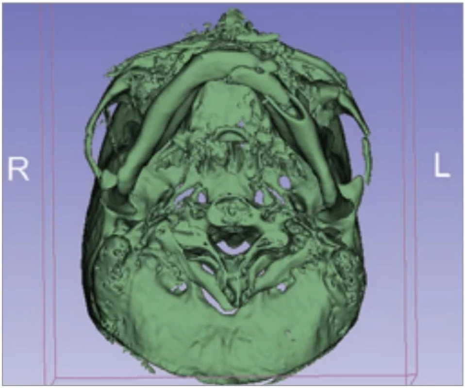 Condyle position on axial 3D reconstruction.