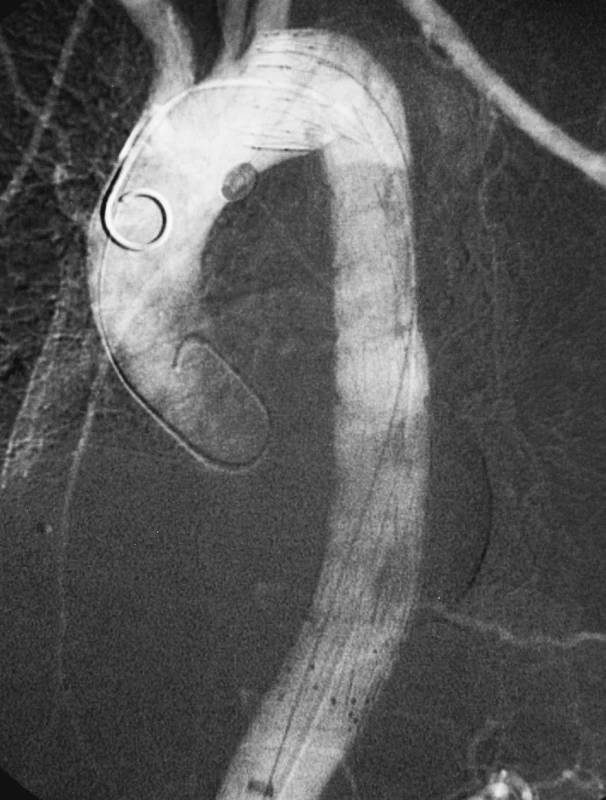 Stav po úspěšném zavedení hrudního stentgraftu
Pic. 7. Thoracic stentgraft, successfully introduced