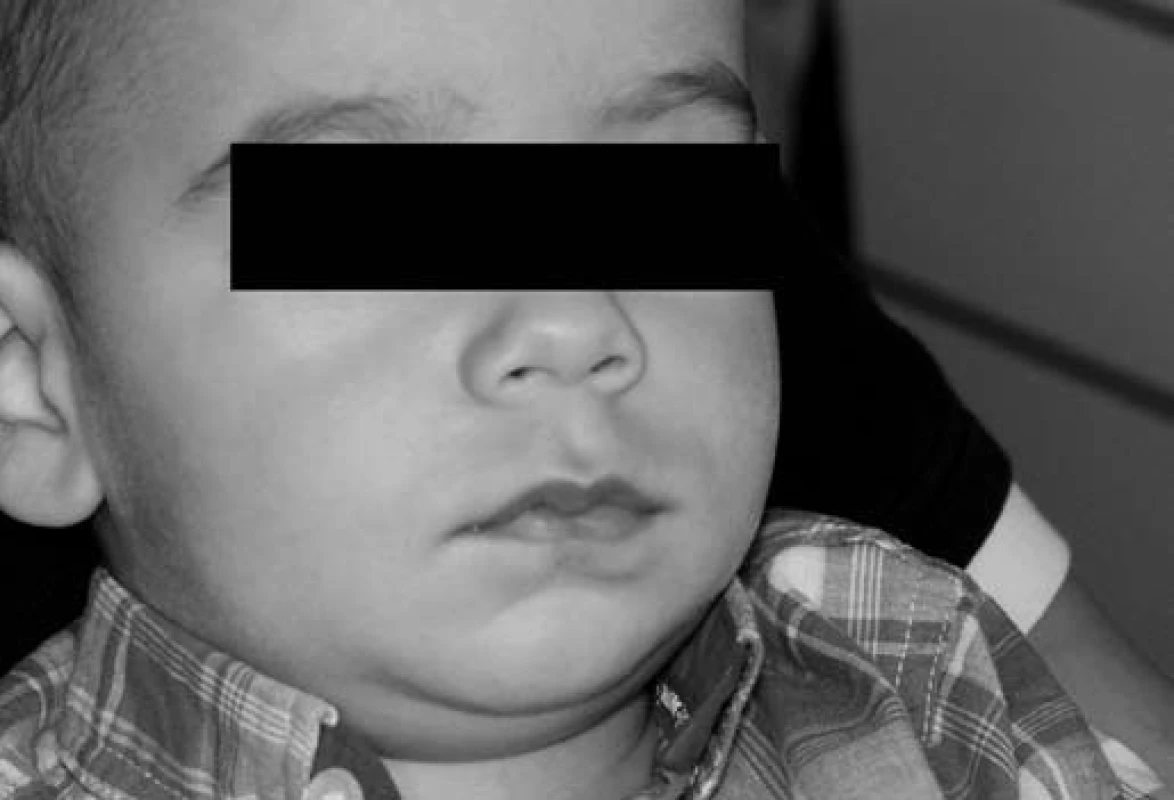 Dítě po podání analgosedace.
Fig. 3. The child after interpretation the analgosedation.