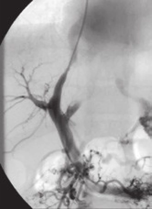 Intimální hyperplazie v oblasti jaterní žíly (jeden rok po zavedení TIPS).
Fig. 6. Intimal hyperplasia in the hepatic vein (one year after the introduction of TIPS).