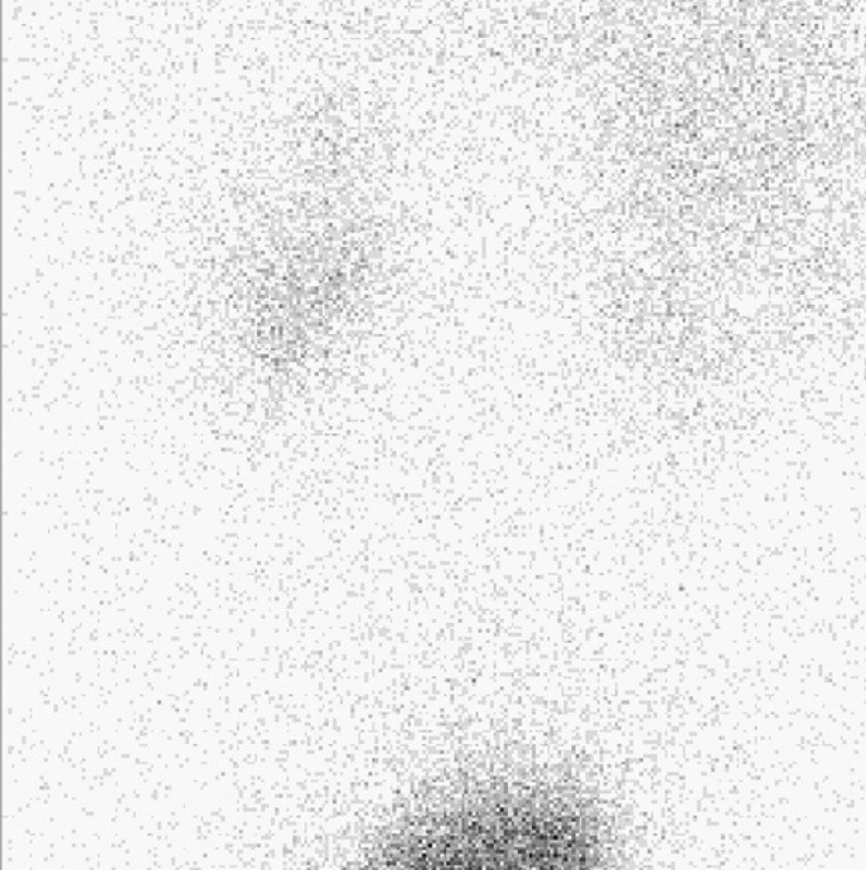 Kontrolní scintigram po skončení studie, bez retencí aktivity v dutém systému.
Fig. 6. A control scintigraphy after the end of the study, without retention of activity in the hollow system.