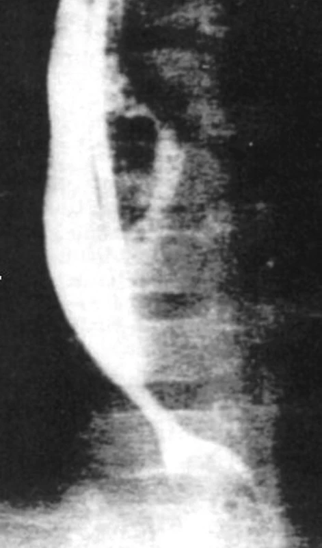 Refluxní striktura před dilatací a operací.
Fig. 1.Reflux stricture before dilation and surgery.