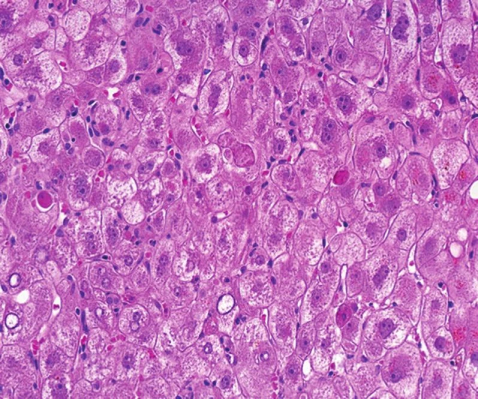 Fibrocholestatická hepatitida (lytická forma) s nápadným individuálním zánikem hepatocytů (četná acidofilní tělíska) a metabolickými změnami hepatocytů. Ve vzorku je patrná aktivita Kupfferových buněk a minimum zánětu (HE, objektiv 40x).