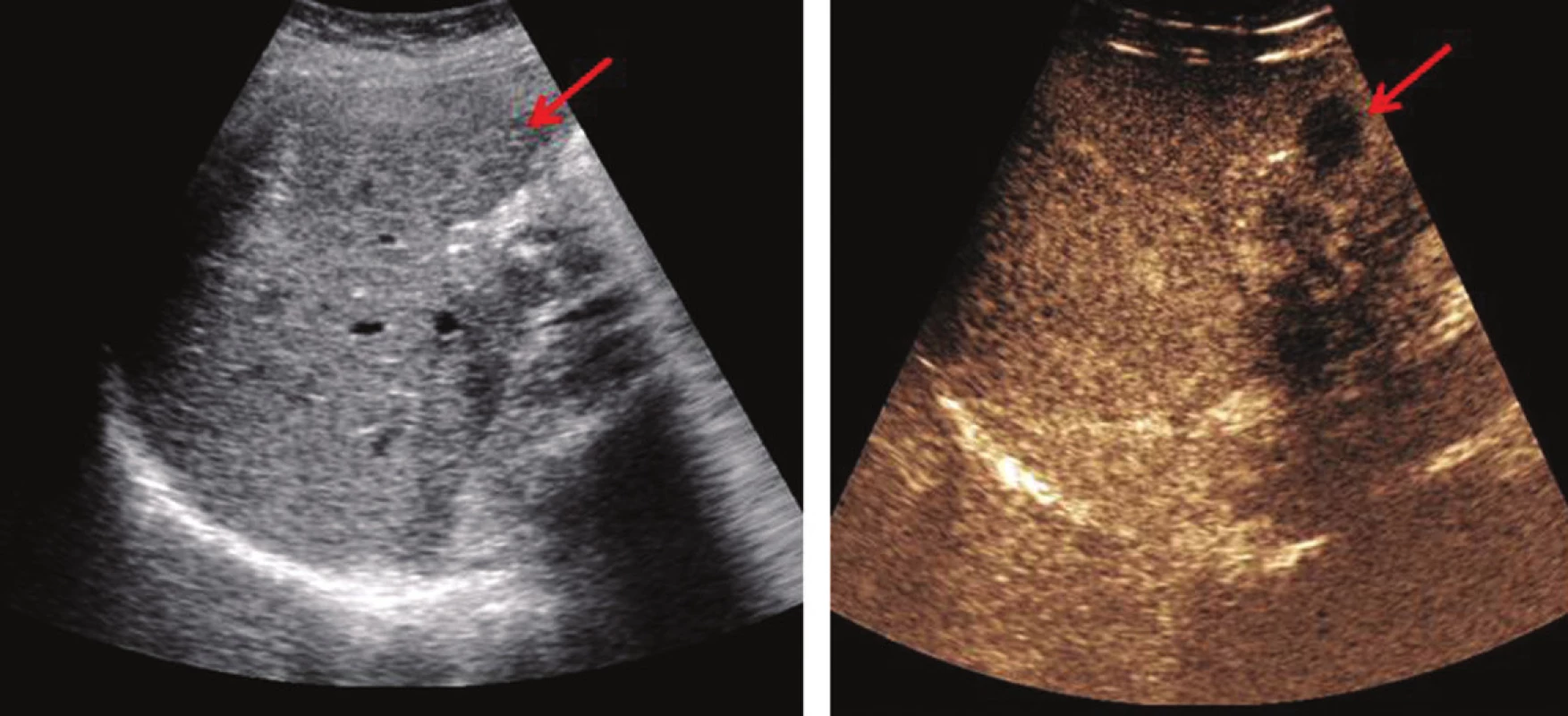 USG jater nativně – JMKRK není patrná (vlevo – šipka), CEUS − zvýraznění hypoechogenní JMKRK (vpravo − šipka)
Fig. 1: Native USG of the liver – CLM not visible (left – the arrow); CEUS – enhanced hypoechoic CLM (right – the arrow)