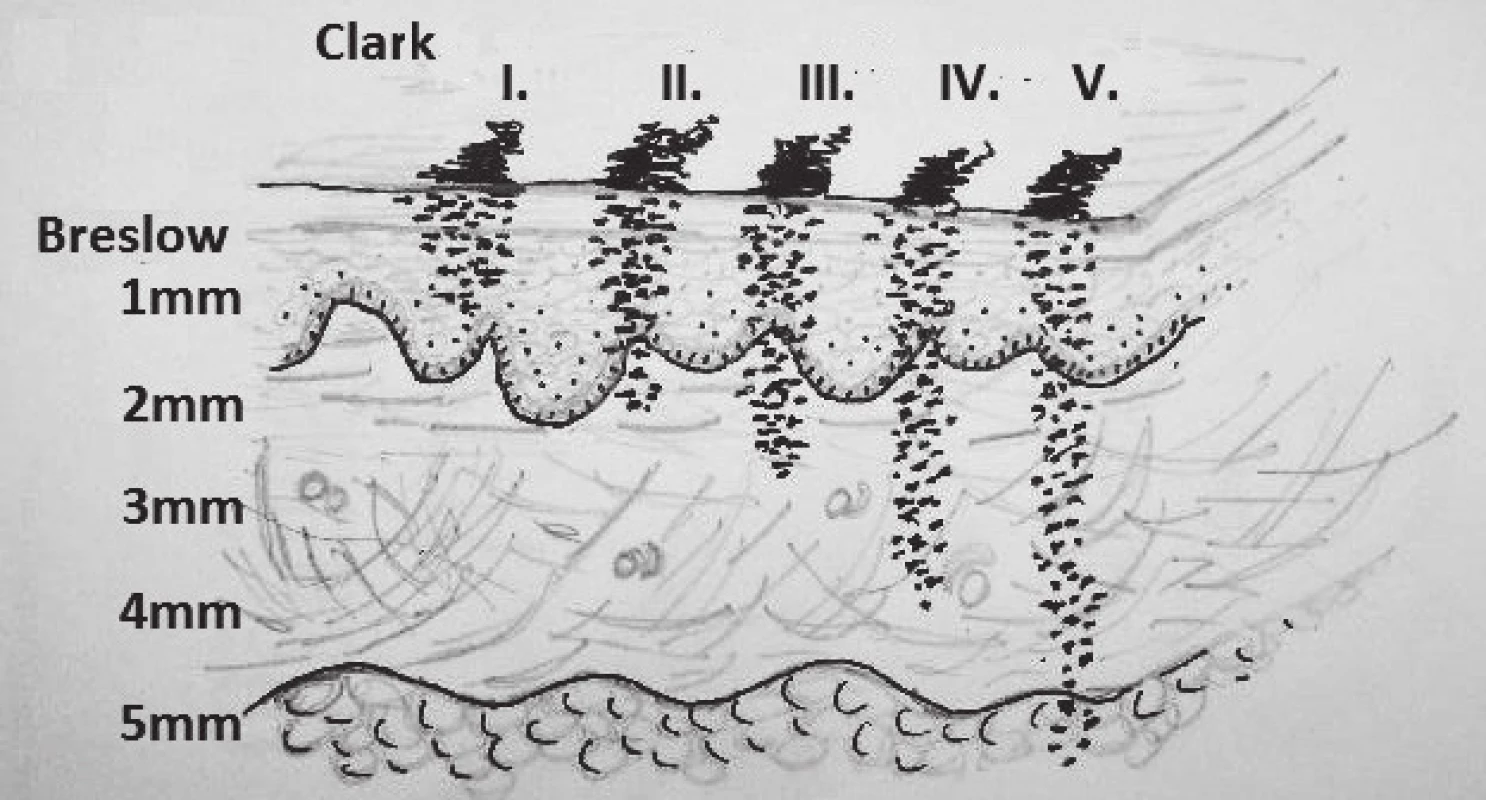 Breslow, Clark classification