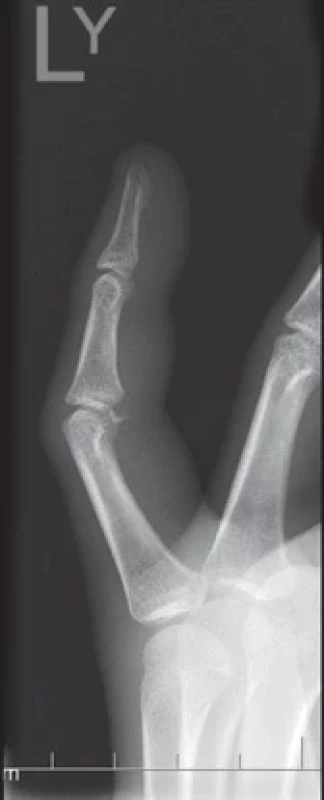 An instable proximal interphalangeal joint volar plate injury with large displaced fragment for operative treatment.