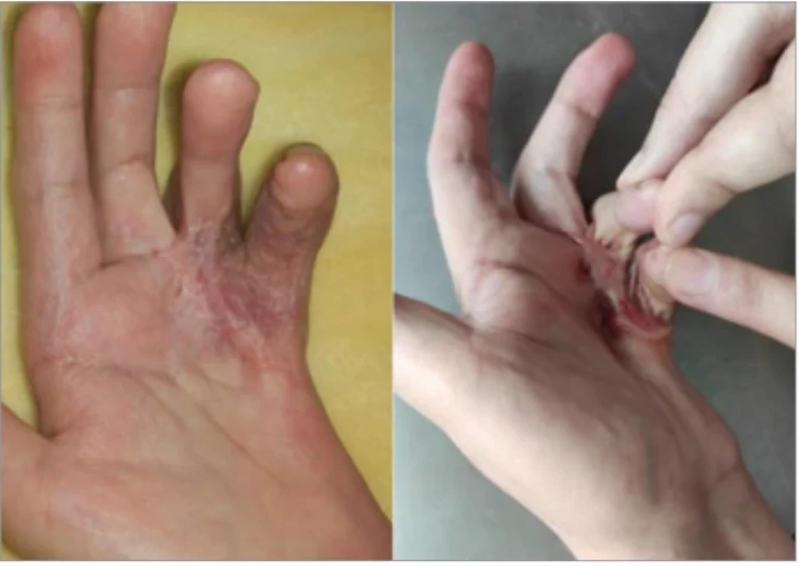 Immediate and late postoperative result (6 months after surgery).
