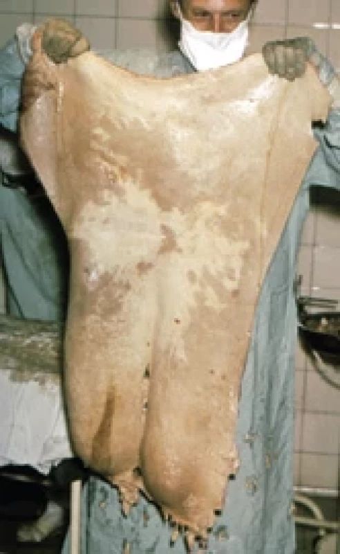 Prof. Bařinka holding removed tissue aff ected by elephantiasis.
