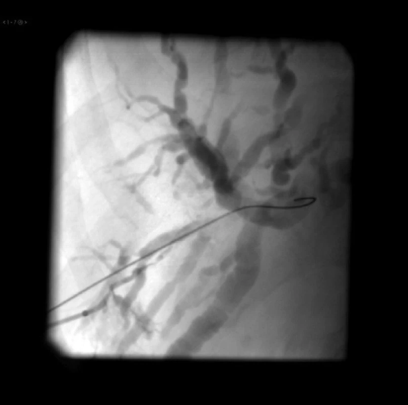 Uzáver punkčného kanála v pečeni fibrínovou penou s kontrastom
Fig. 9: Occlusion of the puncture canal in the liver by fibrin foam with contrast