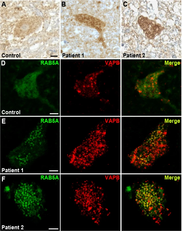 RAB5 accumulates in the cytoplasm of spinal cord neurons of patients with ALS.