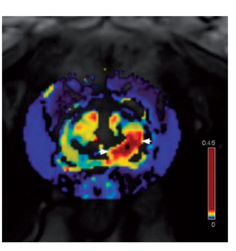 Farmakodynamická analýza – ložisko hypervaskularizace v levém periferním laloku jako známka karcinomu 
Fig. 2. DCE (dynamic contrast enhanced) MRI – tumor focus in the left peripheral zone (region of hypervascularization)