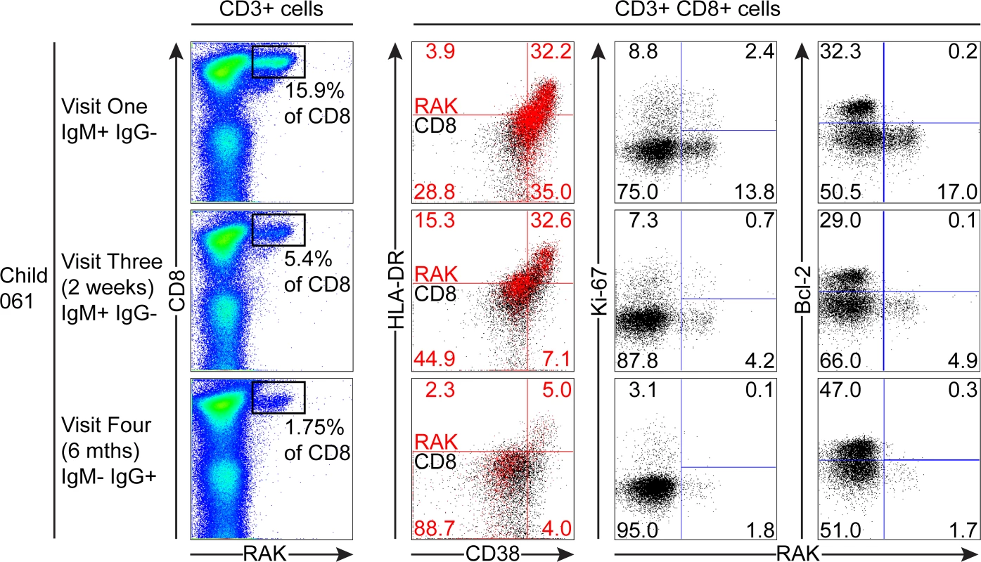 Prospective analysis of EBV-specific CD8+ T cell response and phenotype of PBMCs from a child very recently infected (IgM+ IgG−) at visit one.