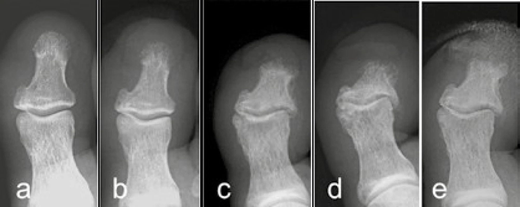 Vývoj osteomyelitidy
