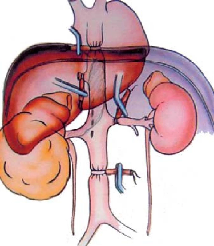 Tumor pravé ledviny s trombem hladiny III (turniket nad horní plochou jater, ostatní stejně jako u hladiny II) [24].