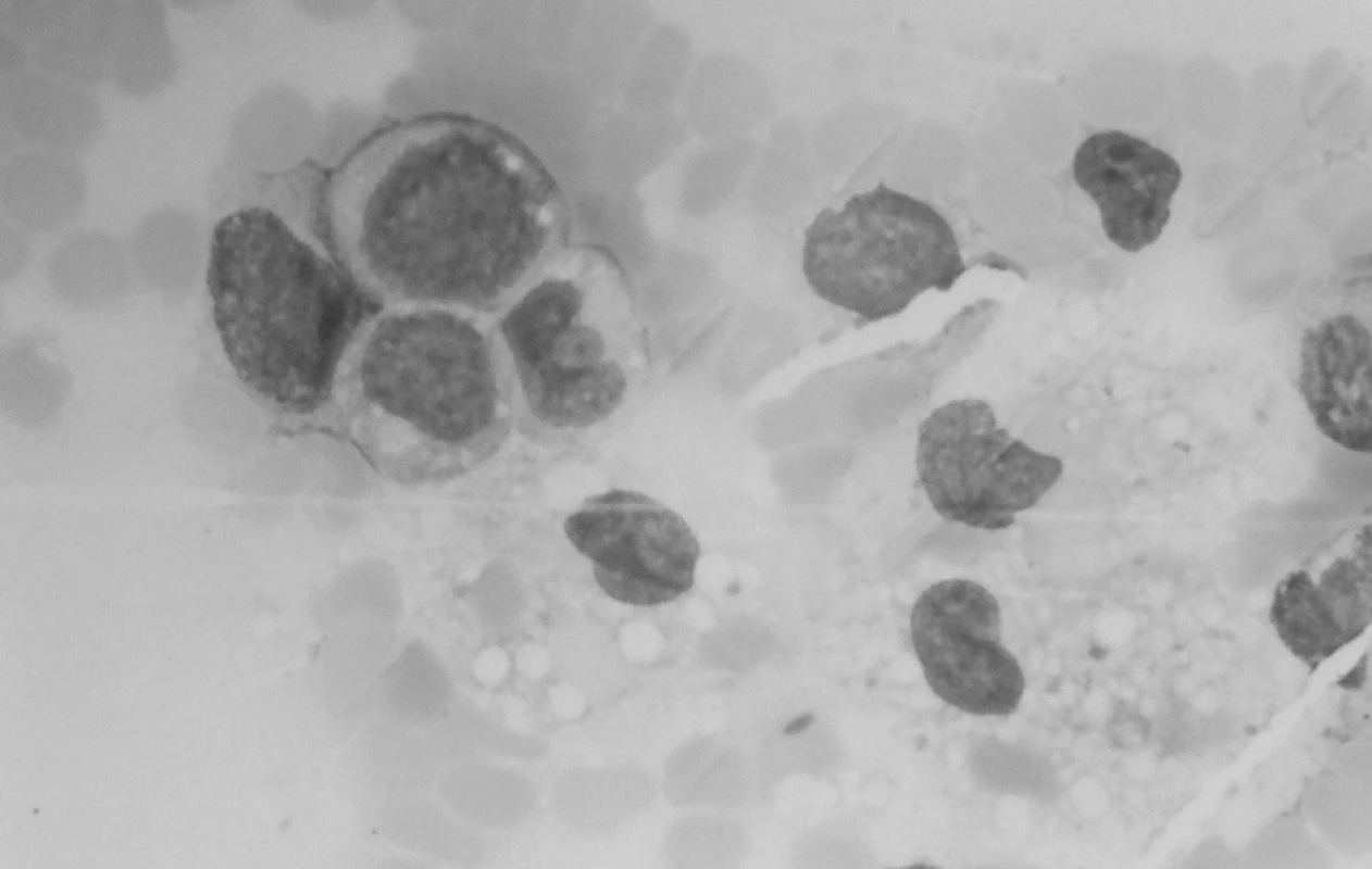 Punkcia kostnej drene: blastická infiltrácia drene a makrofágy.
Fig. 6. Puncture of bone marrow: blastic infiltration of bone marrow with macrophages.