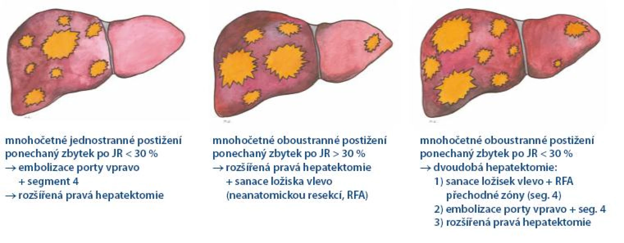 Strategie léčby primárně neresekabilního metastatického postižení jater.