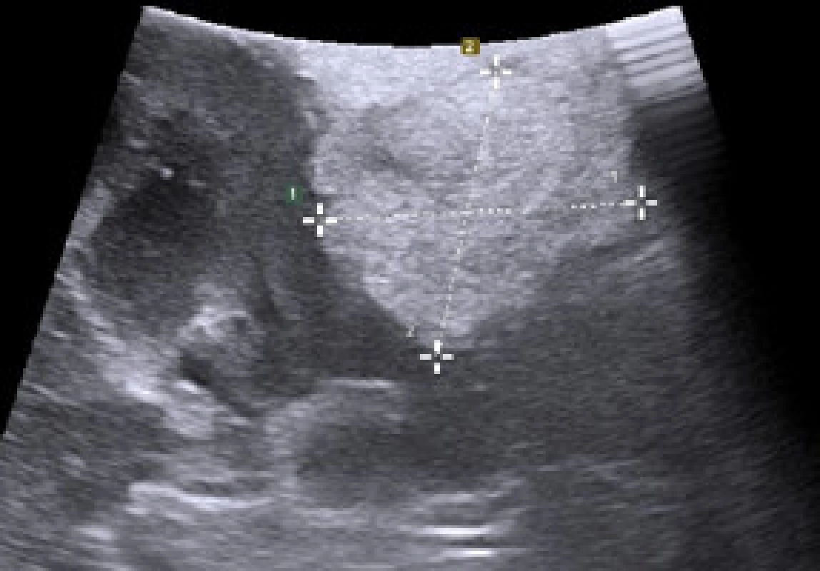 Žena ve věku 47 let, sledována pro trombocytopenickou purpuru s náhodným nálezem exofyticky rostoucího tumoru levé ledviny cT1aN0MX, RENAL skóre 5a, který byl na CT popsán jako hypodenzní nehomogenní, ale ostře ohraničený suspektní renální karcinom o rozměrech na příčném řezu 36 x 22 mm
Fig. 1. A 47-year-old female followed for thrombocytopenic purpura with an incidental finding of an exophytic growing tumour of the left kidney cT1a-N0MX, RENAL score 5a, that was described on CT as hypodense, non-homogeneous, but sharply demarcated suspected renal carcinoma with cross-sectional dimensions of 36 x 22 mm
Obr. 1a. Peroperačně bylo provedeno USG pomocí laparoskopické sondy. Tumor je solidní s ložisky hyperechogenní tkáně svědčící pro tuk
Fig. 1a. A USG using a laparoscopic probe was performed intraoperatively. The tumour is solid with foci of hyperechogenic tissue suggestive of fat