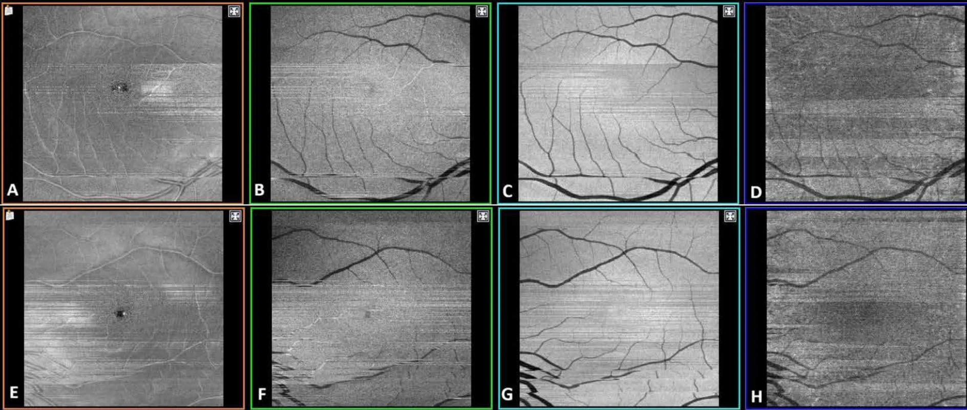 En face snímky pořízené optickou koherenční tomografií (OCT) pravého (A  až D) a  levého (E až H) oka byly normální v zobrazení superficiláního plexu (A, E), hlubokého plexu (B, F), vnějších vrstev sítnice (C, G) a vrstev choriokapilaris (D, H) 