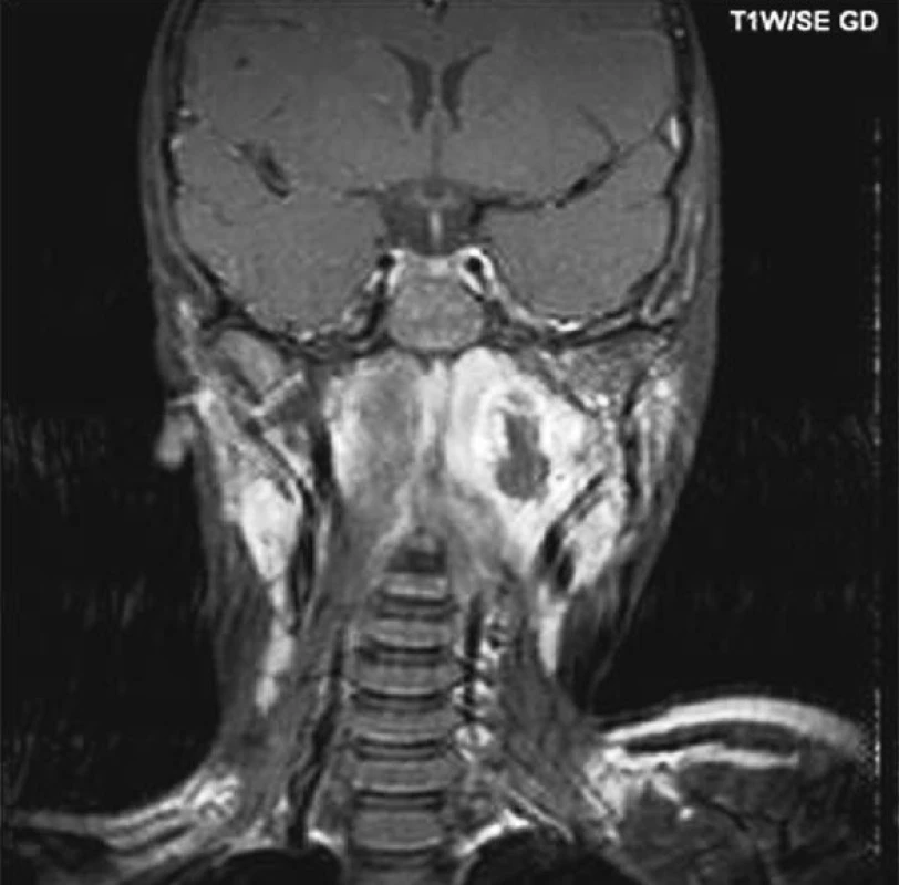 Parafaryngeální absces vlevo (NMR).
