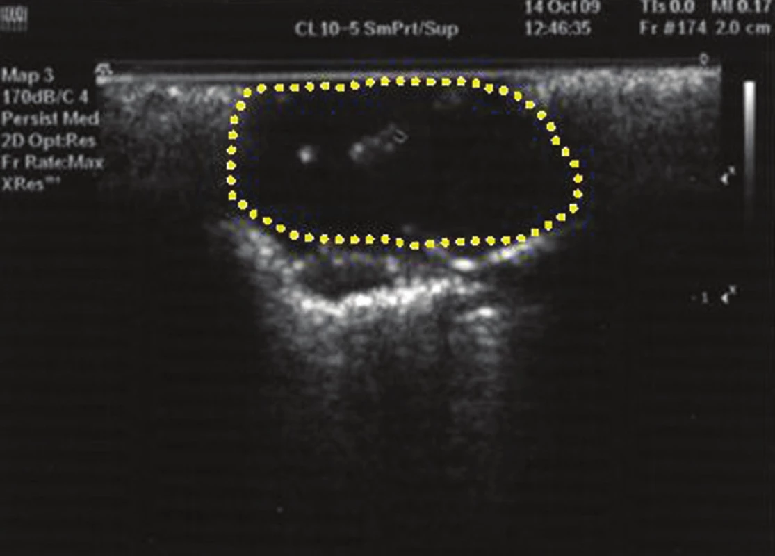 Nález maligního tumoru plic při sonografii endoskopickou UZ sondou
Pic. 4. Display of malignant pulmonary tumour through the endoscopic ultrasonic sonde