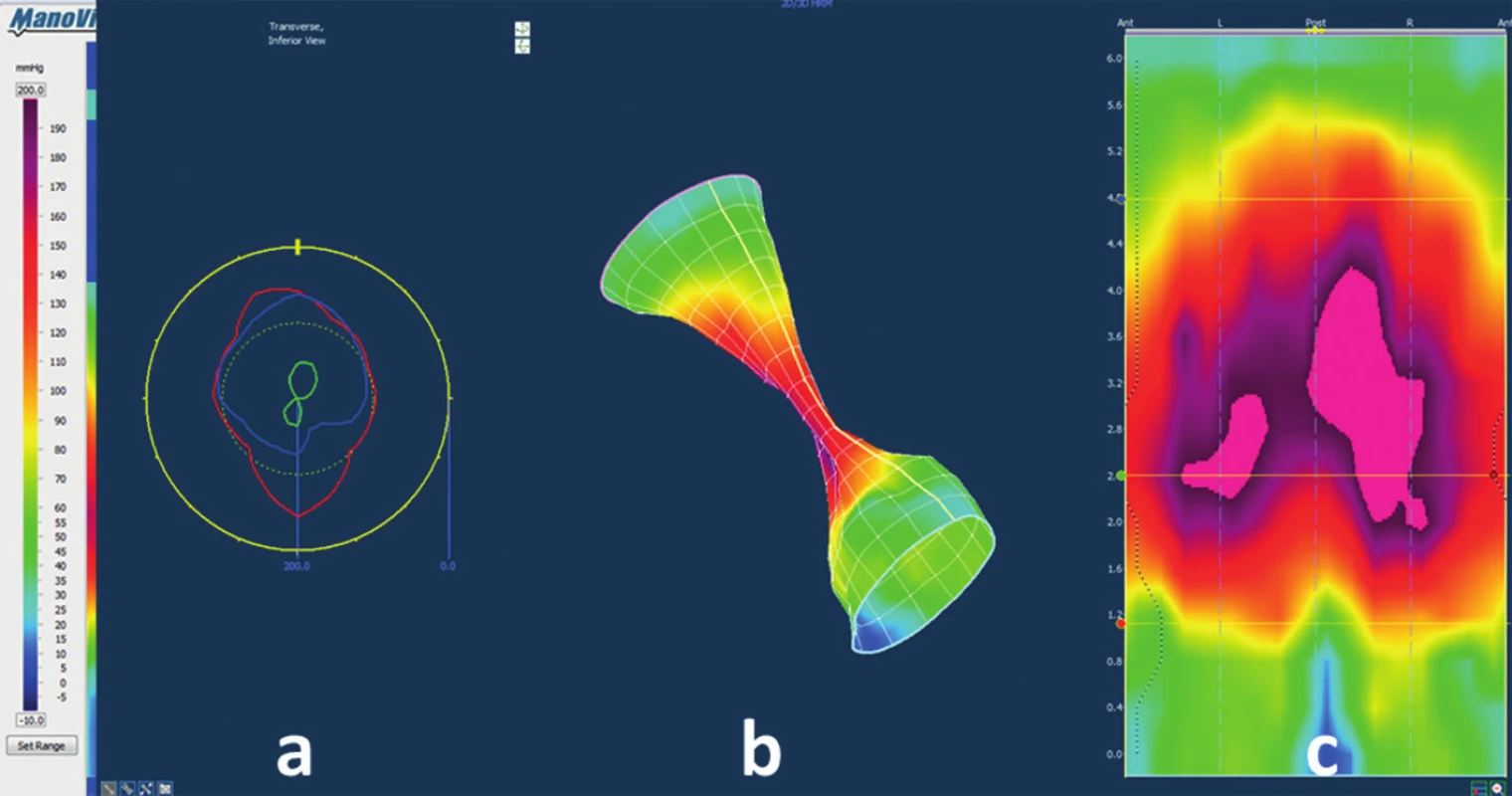 Anorectal pressure morphology during the squeeze manoeuvre