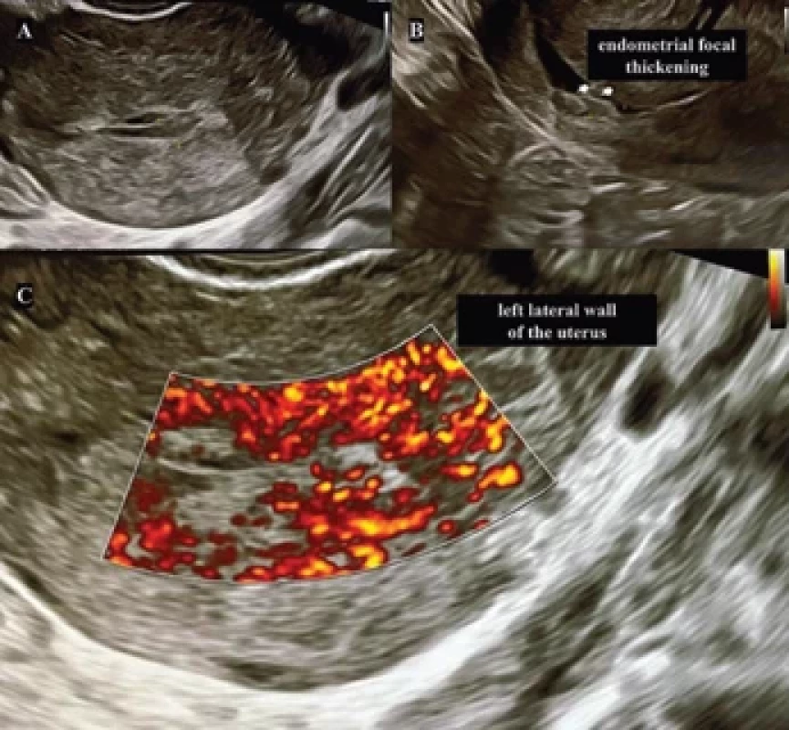 Pelvic-transvaginal ultrasound, showing focal, heterogeneous endometrial thickening in the left cornual uterine region (A and B), followed by exuberant myometrial vascularization in this topography (C). Obr. 1. Pánevní transvaginální ultrazvuk, ukazující fokální, heterogenní ztluštění endometria v levé rohové oblasti dělohy (A a B), následované nadměrnou vaskularizací myometria v této topografi i (C).